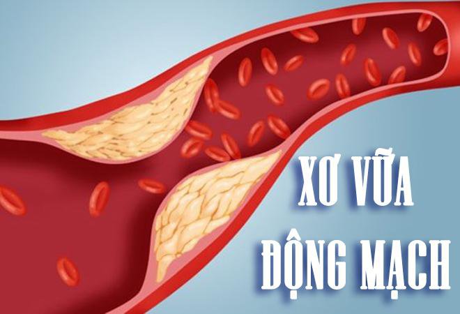 Xơ vữa động mạch là gì và nguy hiểm ra sao?