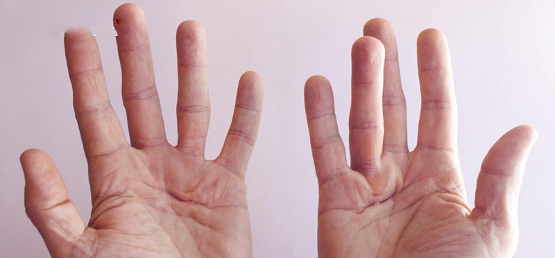 Những biến chứng liên quan cơ xương khớp dễ gặp sau đột quỵ?