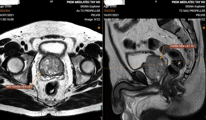 Ai đủ điều kiện chụp MRI tuyến tiền liệt?