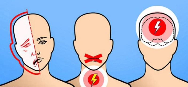 Đột quỵ thường xảy ra với các triệu chứng đột ngột 