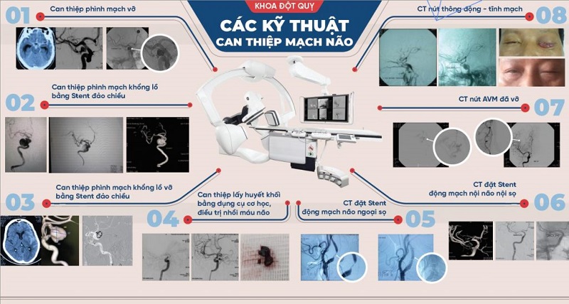 Các kỹ thuật can thiệp động mạch não