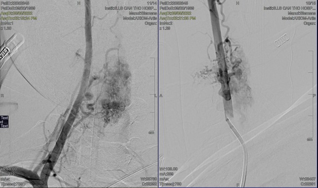 Hình ảnh DSA cho thấy, bệnh nhân bị dị dạng mạch máu tủy cổ gây yếu liệt tứ chi