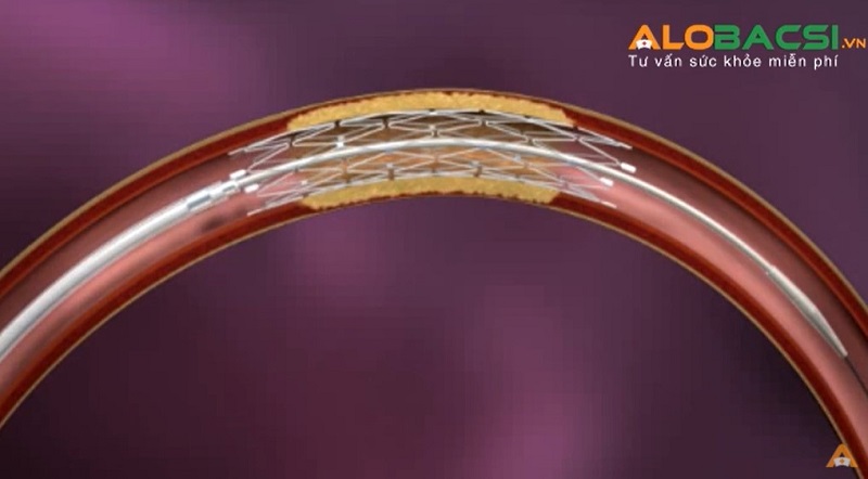 Đặt stent được coi là cuộc cách mạng lớn trong điều trị phình mạch não, đem lại hiệu quả điều trị cao