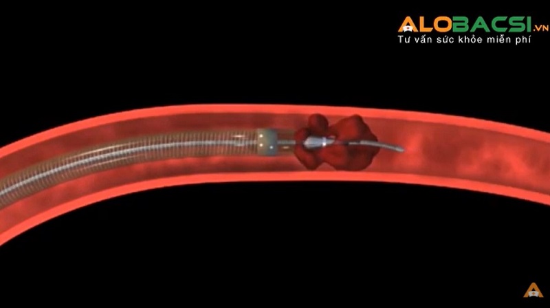 Lấy huyết khối bằng dụng cụ cơ học ở bệnh nhân nhồi máu não