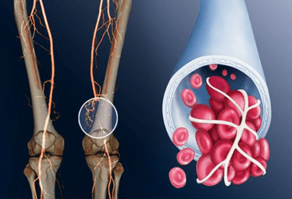 Các loại bệnh do huyết khối gây ra, bạn đã biết chưa?