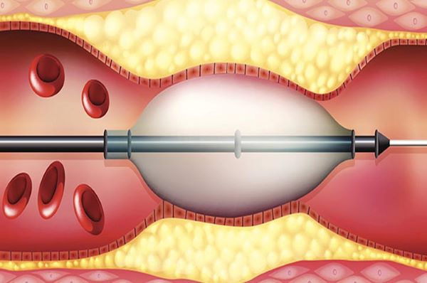 Điều trị hẹp động mạch cảnh bằng phương pháp can thiệp nội mạch giúp tái lập lưu thông dòng máu lên não, giảm đáng kể nguy cơ nhồi máu não và cơn thiếu máu não thoáng qua.