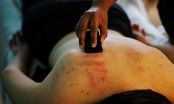 Không nên cạo gió, vắt chanh cho vào miệng bệnh nhân bởi điều này có thể gây tắc nghẽn đường thở.