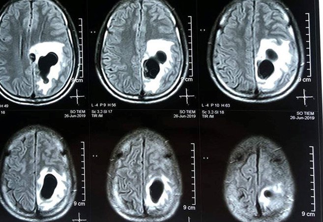 MRI sọ não giúp chẩn đoán nhanh chóng, phát hiện chính xác các bất thường tại não.