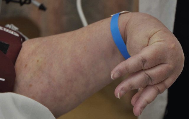 Khoảng 2/3 bệnh nhân sống sót sau bị co cứng sau đột quỵ.