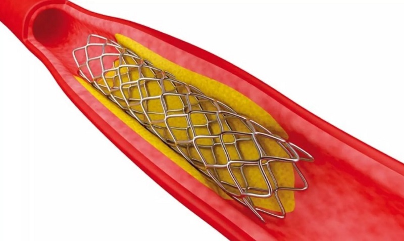 Stent là một lưới kim loại nhỏ để mở rộng lòng mạch và phục hồi lưu lượng máu