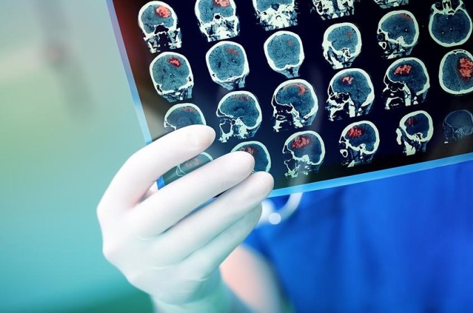 Đột quỵ im lặng là dạng đột quỵ không gây ra bất kì khuyết tật nào cho cơ thể.