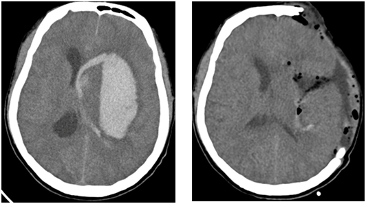 Phẫu thuật giảm áp là phương pháp can thiệp ngoại khoa hữu hiệu và phổ biến.