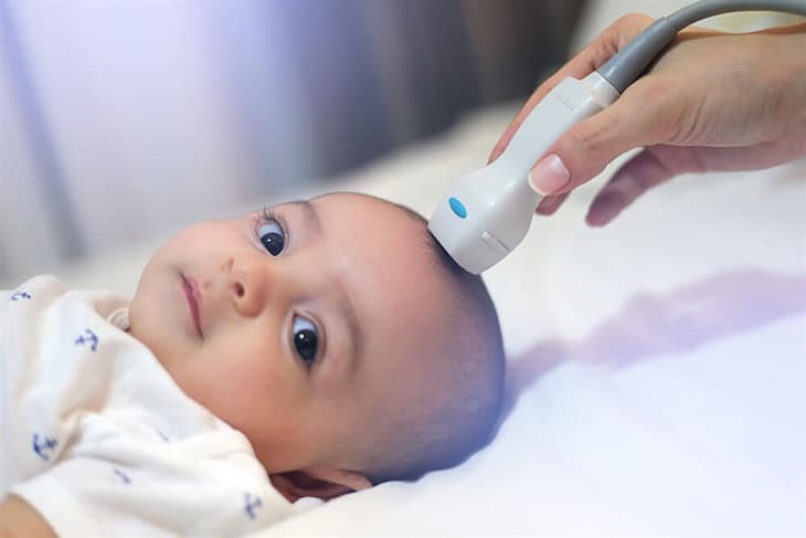 Siêu âm sọ giúp bác sĩ chẩn đoán đột quỵ thiếu máu não cục bộ ở thời kỳ chu sinh