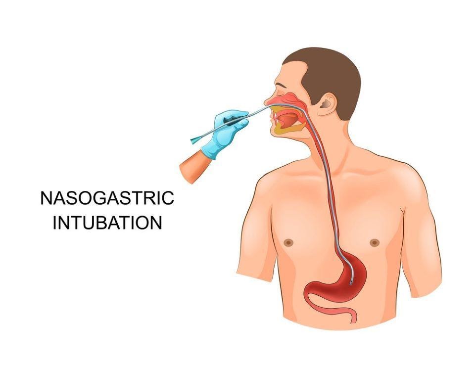 Phương pháp giúp bệnh nhân cải thiện chức năng nuốt sau đột quỵ?
