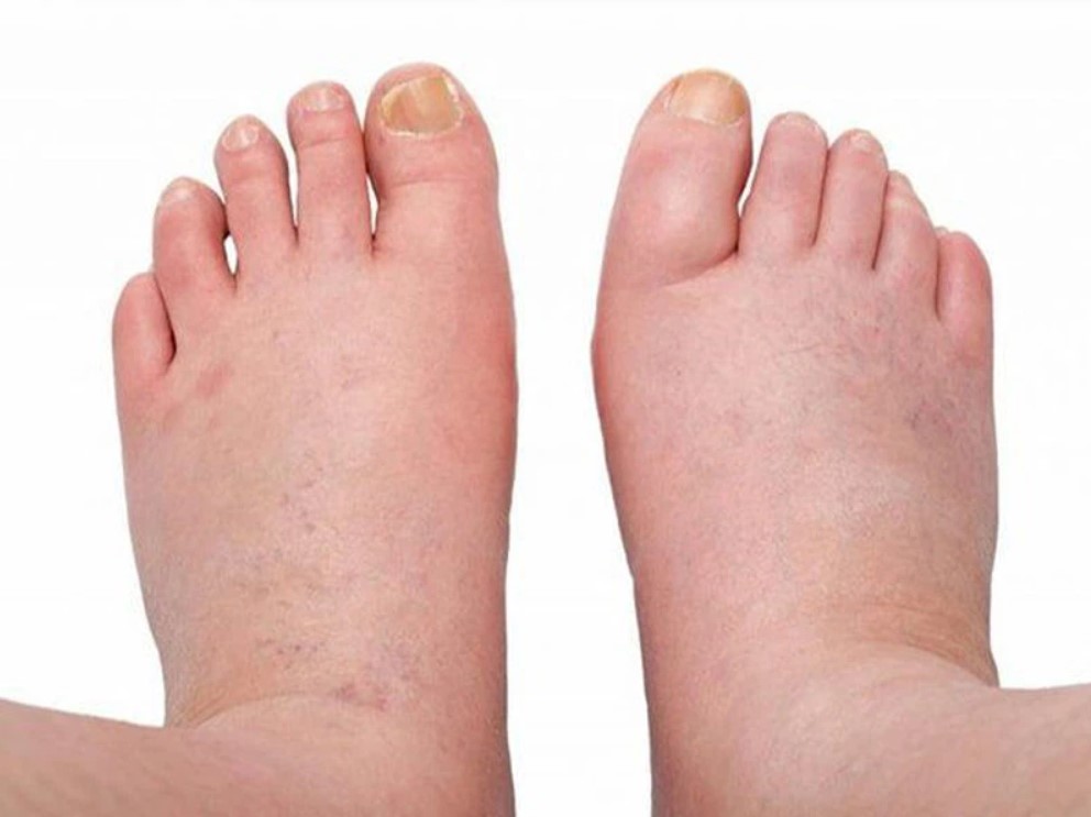 Coversyl có thể gây ra các tác dụng phụ không mong muốn, chẳng hạn như phù mạch.