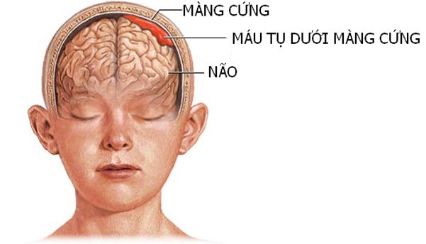 Đau đầu, buồn nôn và ói mửa: Cảnh giác với tụ máu dưới màng cứng