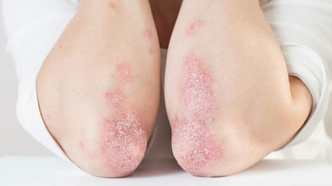 Mối liên hệ giữa đột quỵ và bệnh vảy nến