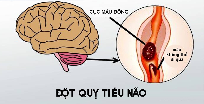 Đột quỵ tiểu não là gì, dấu hiệu nào nhận biết?