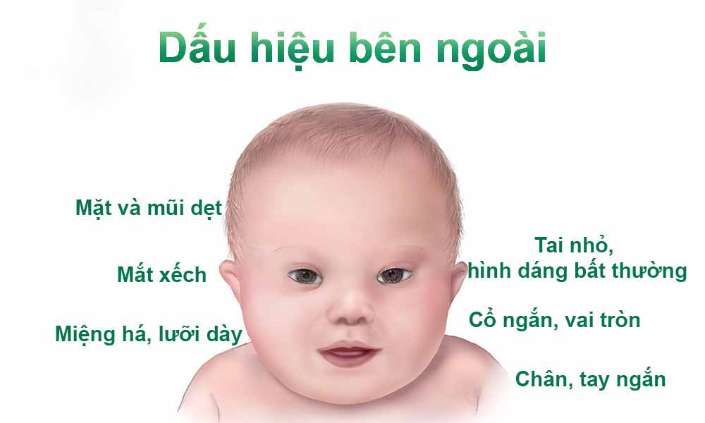 Hội chứng Down là một trong những bất thường hình thái của số lượng nhiễm sắc thể thường gặp ở những phụ nữ sinh con khi ngoài 35 tuổi.