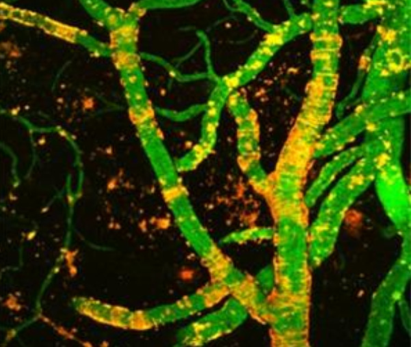 Bệnh mạch máu thoái hoá dạng bột là một bệnh trong đó có sự thoái hóa tiểu động mạch, chất dạng tinh bột lắng đọng trong thành các động mạch não mà không có chỗ nào khác trong cơ thể.