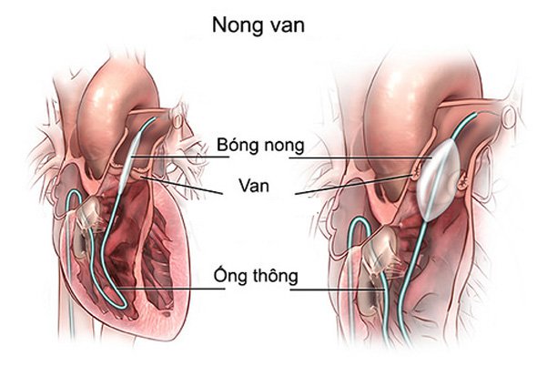 Cốt lõi của điều trị hẹp van động mạch chủ nặng là phẫu thuật thay van động mạch chủ.