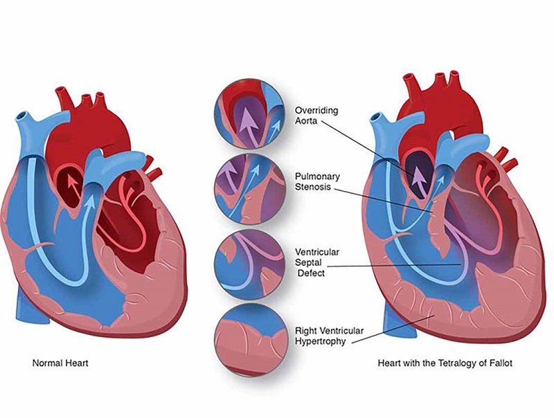 Điều trị tứ chứng Fallot cho hầu hết các trẻ sơ sinh liên quan đến một loại phẫu thuật tim mở gọi là sửa chữa trong tim.