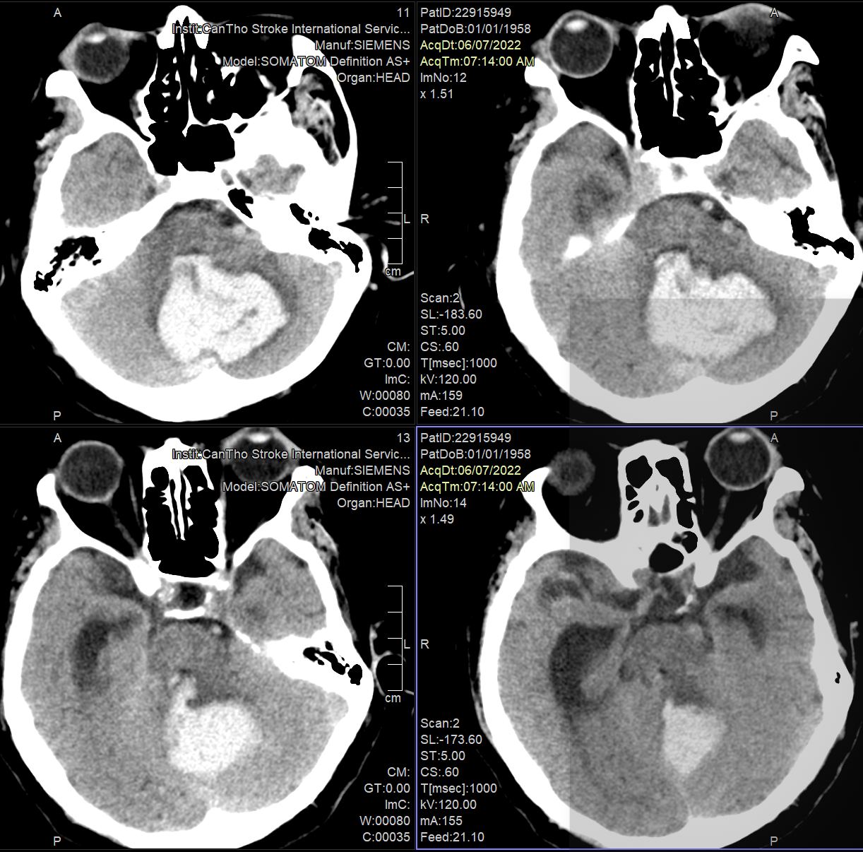 TS.BS Trần Chí Cường: Tỷ lệ bệnh nhân xuất huyết não đang tăng cao