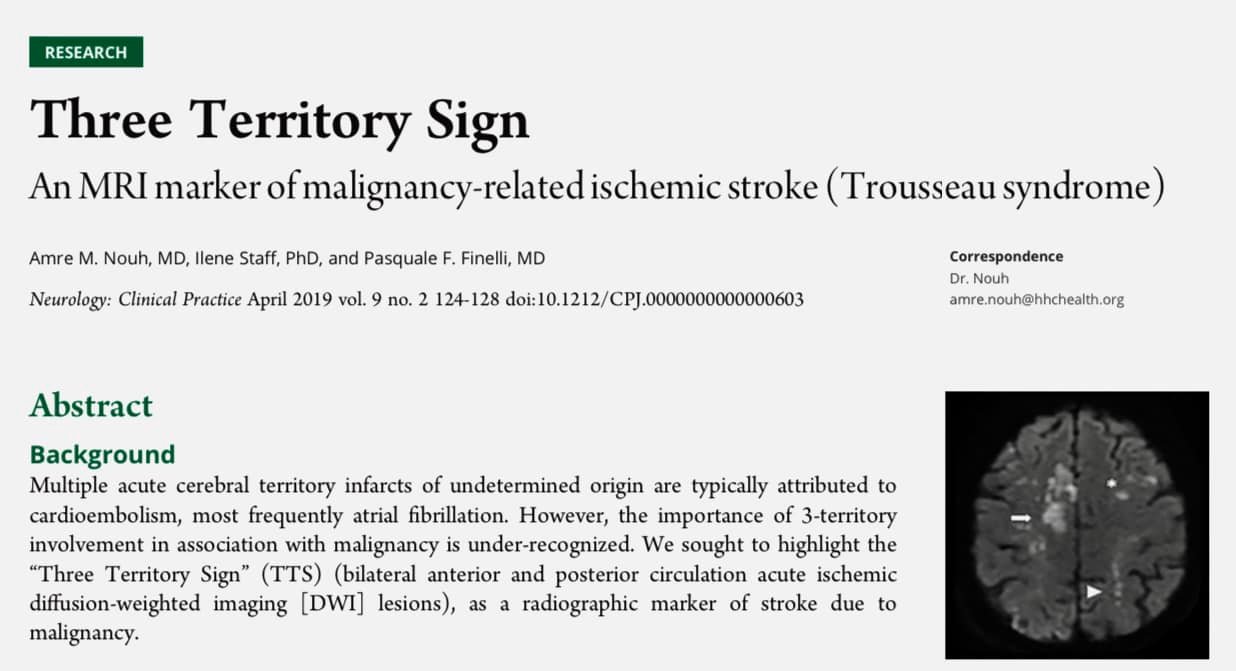 Nhồi máu 3 vùng chi phối động mạch não và hội chứng Troussea