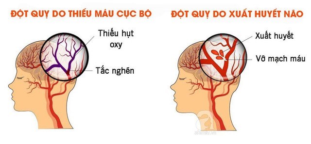 Đột quỵ để lại di chứng nặng nề và lâu dài cho người bệnh, thậm chí tử vong.