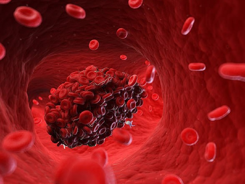 Cục máu đông hình thành sẽ gây tắc nghẽn mạch máu dẫn đến đột quỵ.