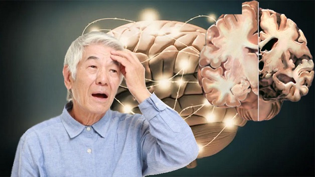 Bệnh Alzheimer: Nguyên nhân và cách phòng ngừa