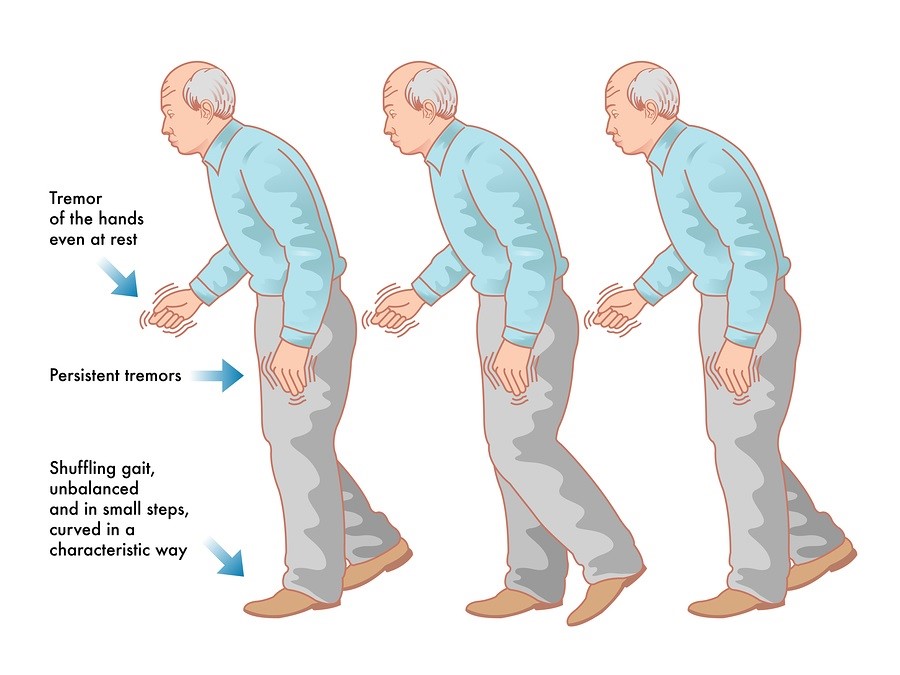 Parkinson là một bệnh rối loạn hệ thần kinh tiến triển ảnh hưởng đến vận động.