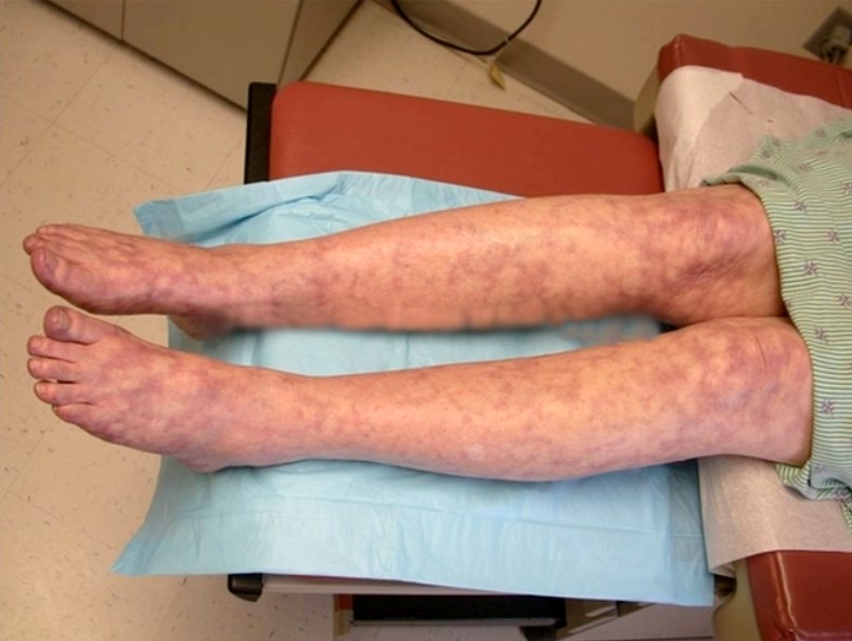 Nhiều người bệnh có mạng lưới xanh tím ở da giống như lưới các tĩnh mạch nông trên bề mặt da.