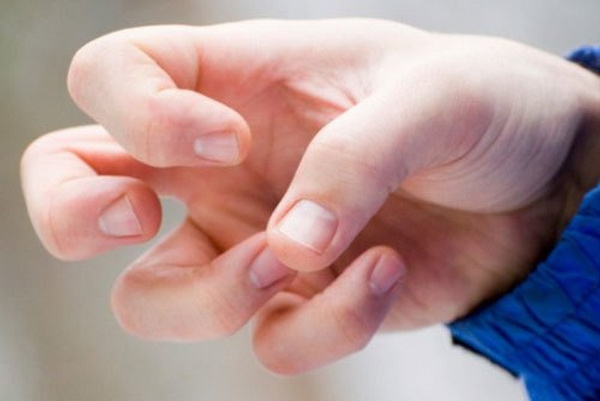 Tại sao người bệnh bị động kinh sau đột quỵ?