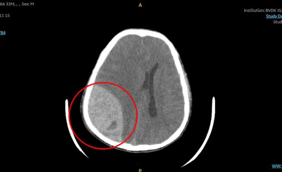 Khối máu tụ đã được lấy đi hoàn toàn và cầm máu, Ảnh:BVCC