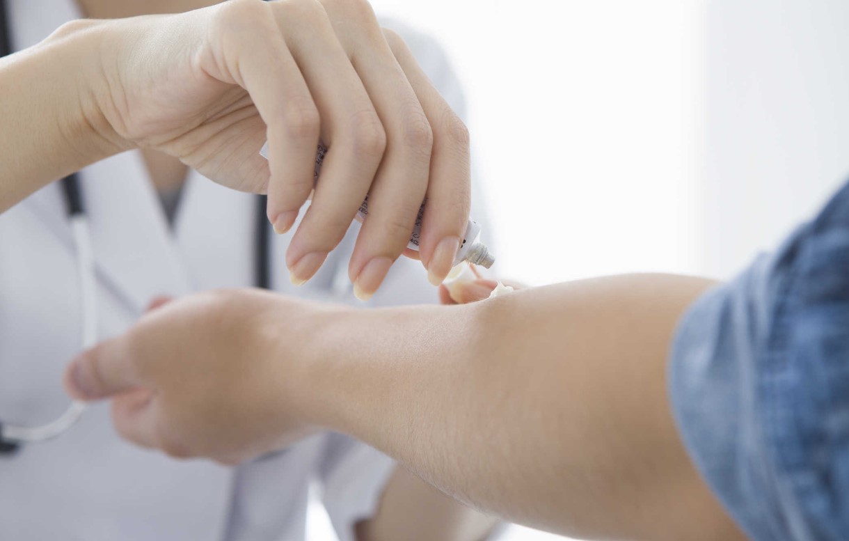 Với các vết loét trên da có thể sử dụng Corticosteroid dạng kem để điều trị.