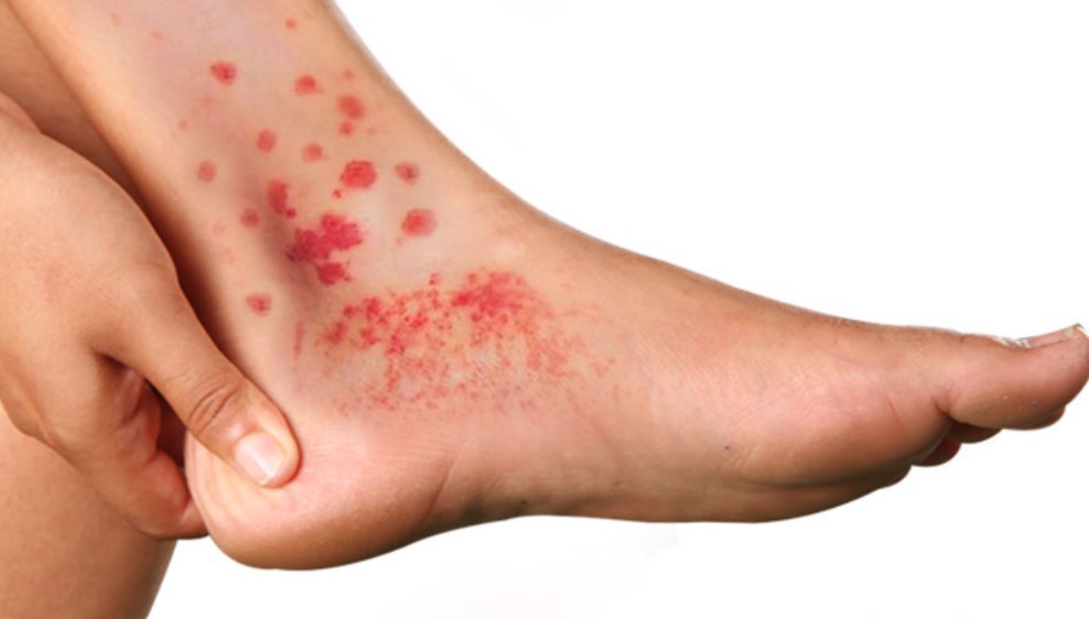 Bệnh Behcet có thể gây nhầm lẫn với các bệnh lý khác.