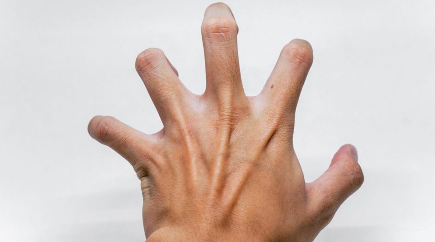 Co giật tay chân sau đột quỵ, nguy hiểm không?