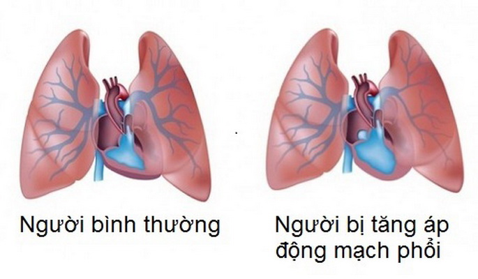Các dấu hiệu và triệu chứng của tăng áp phổi phát triển chậm.