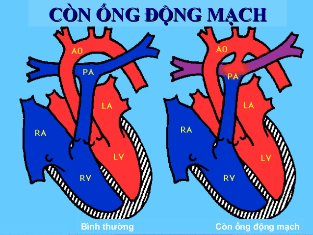 Còn ống động mạch (PDA) là tồn tại ống giữa hai mạch máu lớn nhất từ tim dai dẳng.