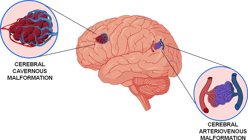 Có nhiều loại dị dạng mạch máu não và mức độ khác nhau.