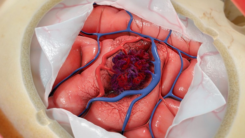 Dị dạng mạch máu não là bệnh bẩm sinh và hết sức nguy hiểm.