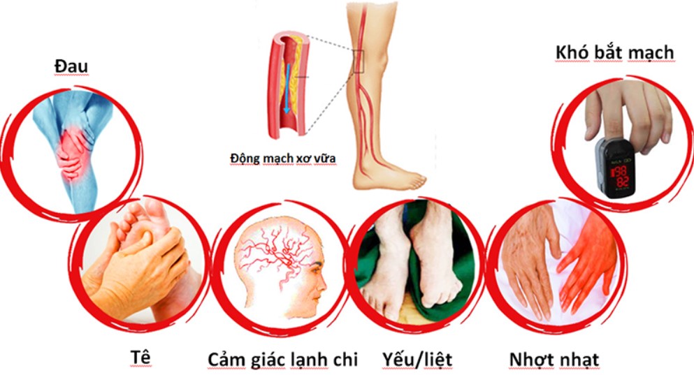 Khoảng 1/2 người bệnh động mạch ngoại biên không có triệu chứng. Những triệu chứng thường gặp nhất là đau, chuột rút, nhức mỏi và tê vùng bị tổn thương.