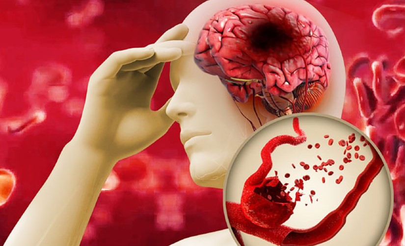 Trước khi sử dụng thuốc Apixaban, hãy cho bác sĩ hoặc dược sĩ biết tiền sử bệnh của bạn, chẳng hạn như đột quỵ.