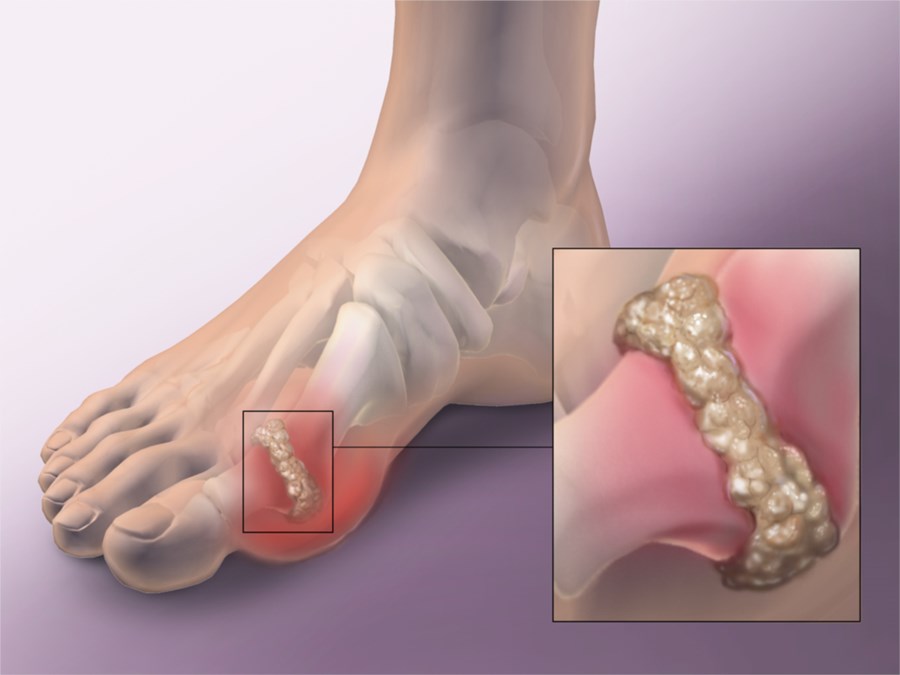 Bị gout sẽ có nguy cơ đột quỵ, đúng hay sai?