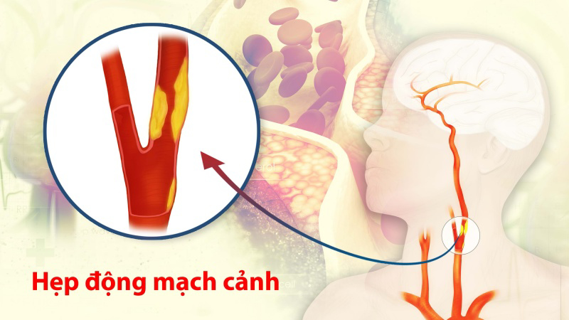 Bệnh động mạch cảnh: Nguyên nhân và các biến chứng nguy hiểm