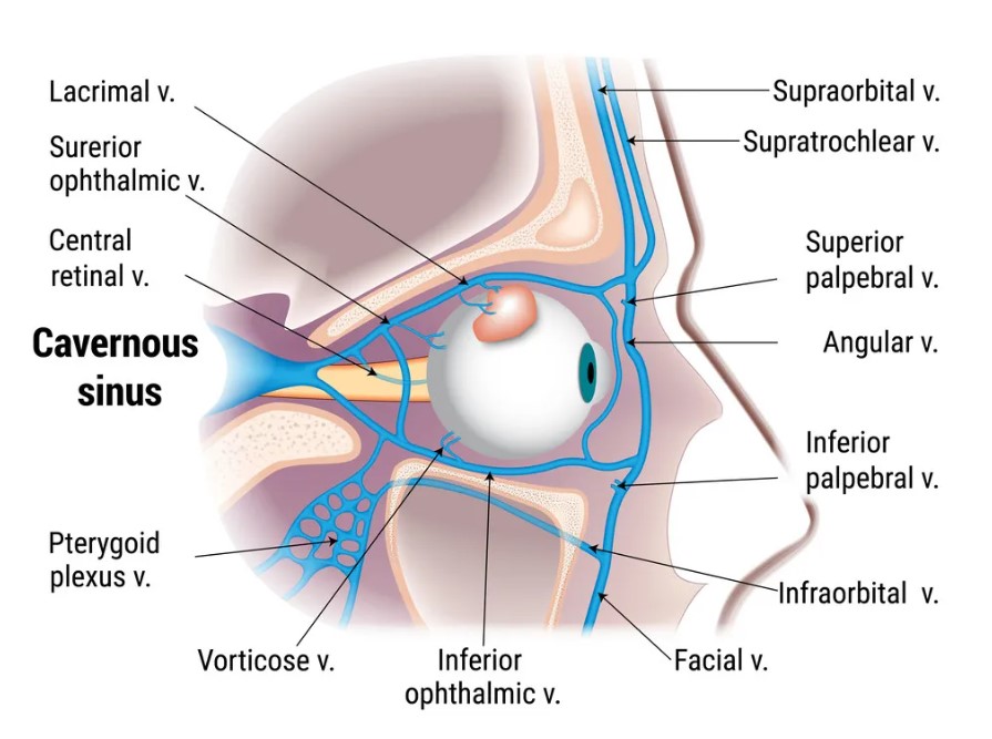 Huyết khối xoang hang là tình trạng nhiễm trùng dẫn đến cục máu đông do biến chứng nhiễm trùng