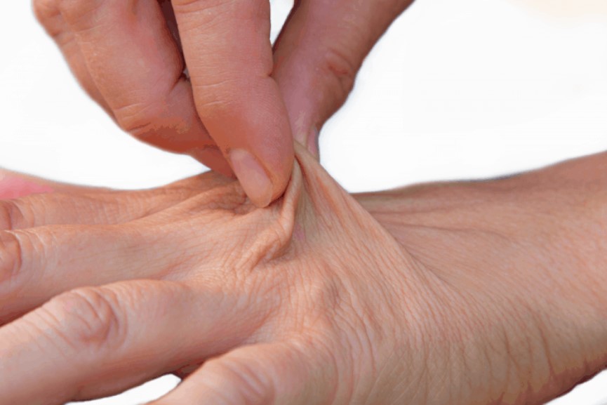 Dùng hai ngón tay véo vào một số phần da trên mu bàn tay và buông ra. Nếu da trở về trạng thái bình thường chậm hơn thì bạn có thể bị mất nước.