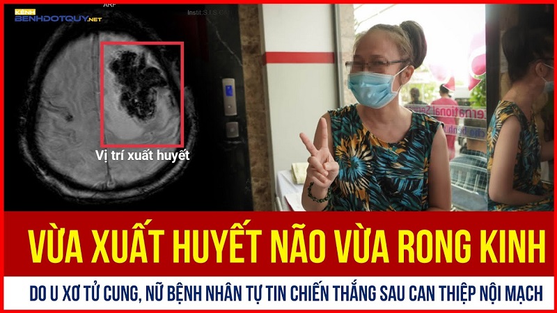 Vừa xuất huyết não vừa rong kinh do u xơ tử cung, nữ bệnh nhân chiến thắng sau can thiệp nội mạch