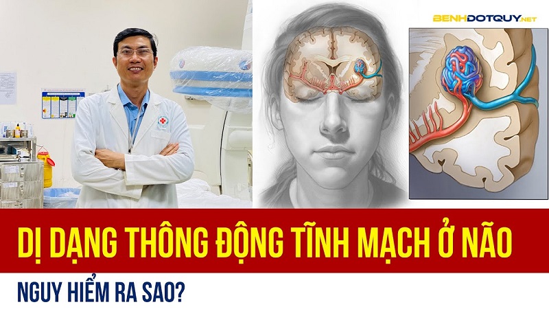 Dị dạng thông động tĩnh mạch ở não nguy hiểm ra sao?